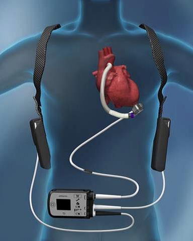 El Hospital La Fe implanta el dispositivo de asistencia cardíaca más av...