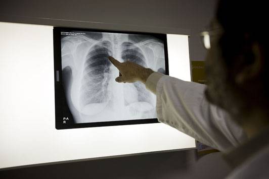 Los casos de tuberculosis descienden un 13% en los últimos cuatro años ...
